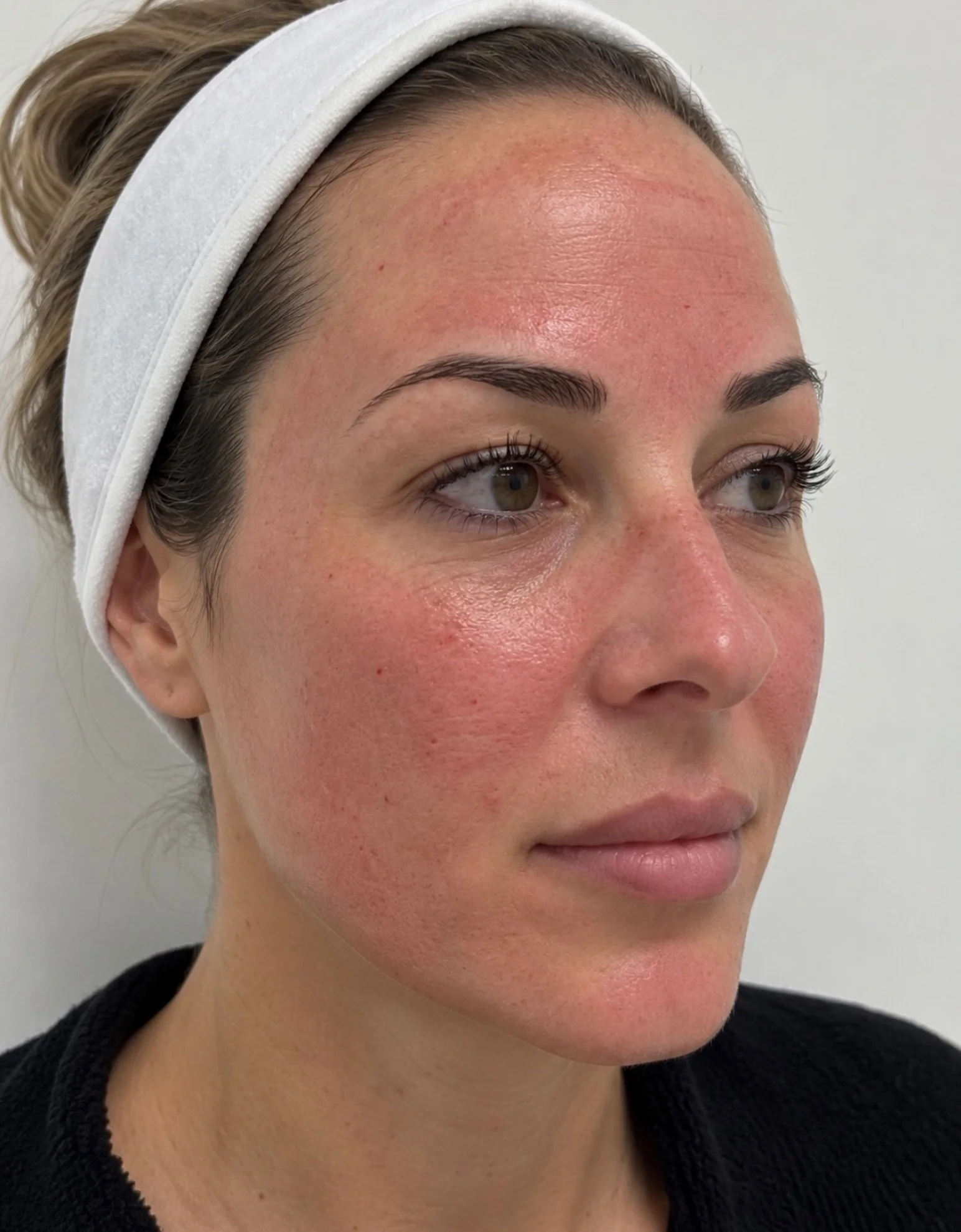 September called. It&rsquo;s officially microneedling season 🧖🏽&zwj;♀️
