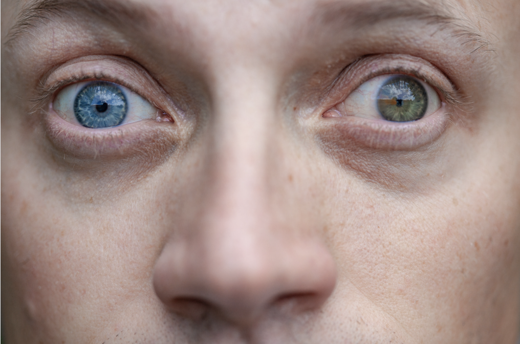 Cataratta: un problema solo dell'occhio o di tutto il sistema?