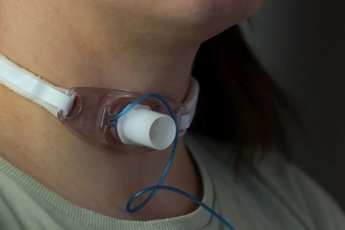 Trachealkanüle am Hals nach Kehlkopfentfernung – logopädische Versorgung und Stimmrehabilitation nach Laryngektomie
