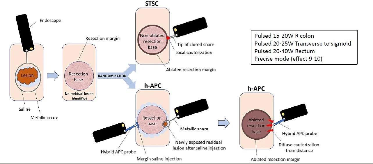 Diagram of a procedure to remove a lesion using endoscopic cauterization and hybrid APC technique. Two methods are shown: non-ablated and ablated resection, with tools like metallic snares and probes, and steps involving saline injections, resection margins, and cauterization.