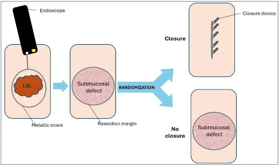 A diagram showing a medical procedure with an endoscope inserting a metallic snare around a submucosal defect, with the potential outcomes of closure with a device or no closure.