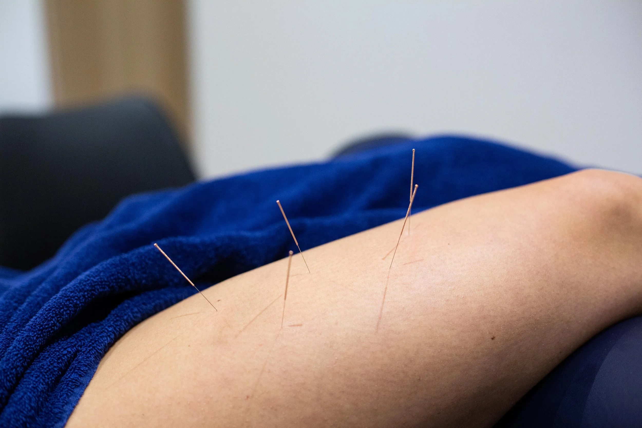 A person's back being treated with acupuncture needles inserted along the back muscles.