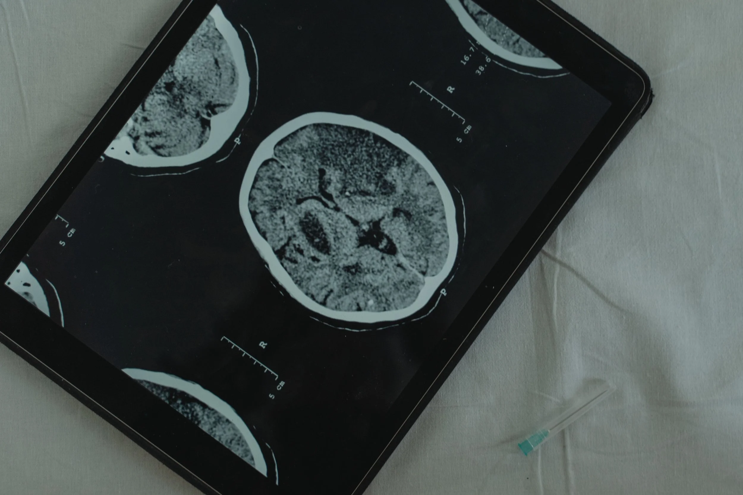 Brain CT scan images on a tablet, used to diagnose a traumatic brain injury or concussion in an injury claim
