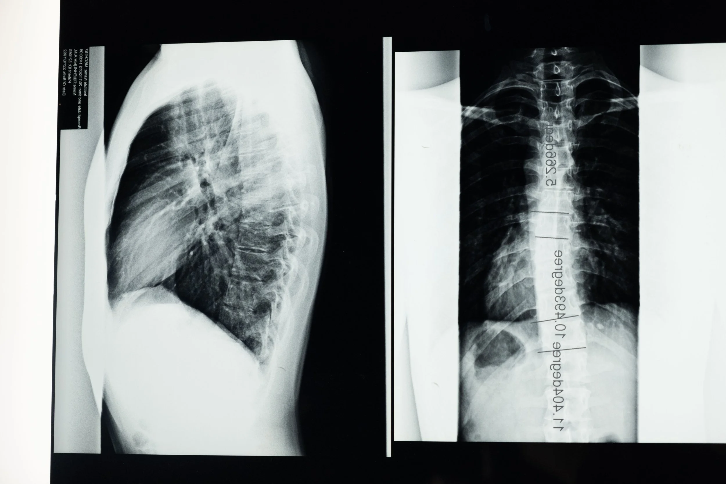 Spine and chest X-ray films, used to diagnose spinal injuries such as herniated discs and fractures