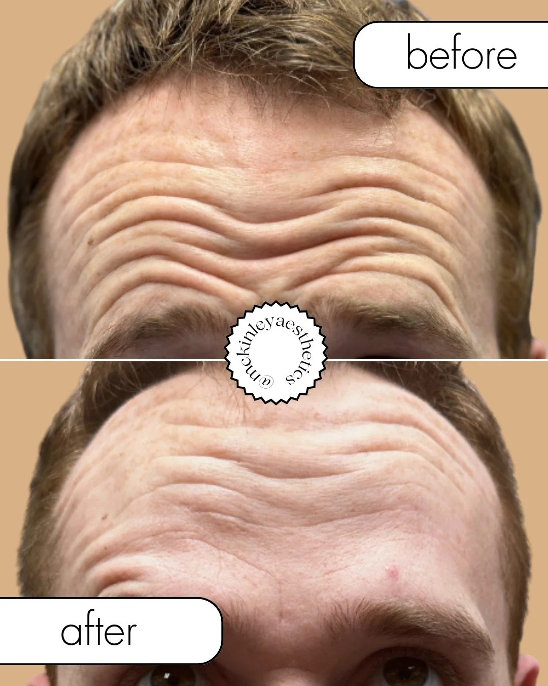 Strong features. Smoother lines.
💉 BOTOX&reg; Cosmetic before &amp; after on a male patient natural results, no &ldquo;frozen&rdquo; look.

New patients can receive $65 off BOTOX&reg; Cosmetic
⏰ Limited time offer. While supplies last. Visit botoxco