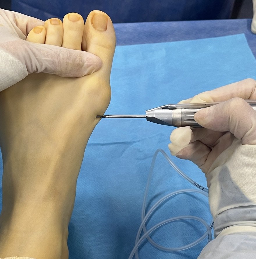 Qué significa Percutánea? Cuál es la diferencia con la cirugía tradicional?