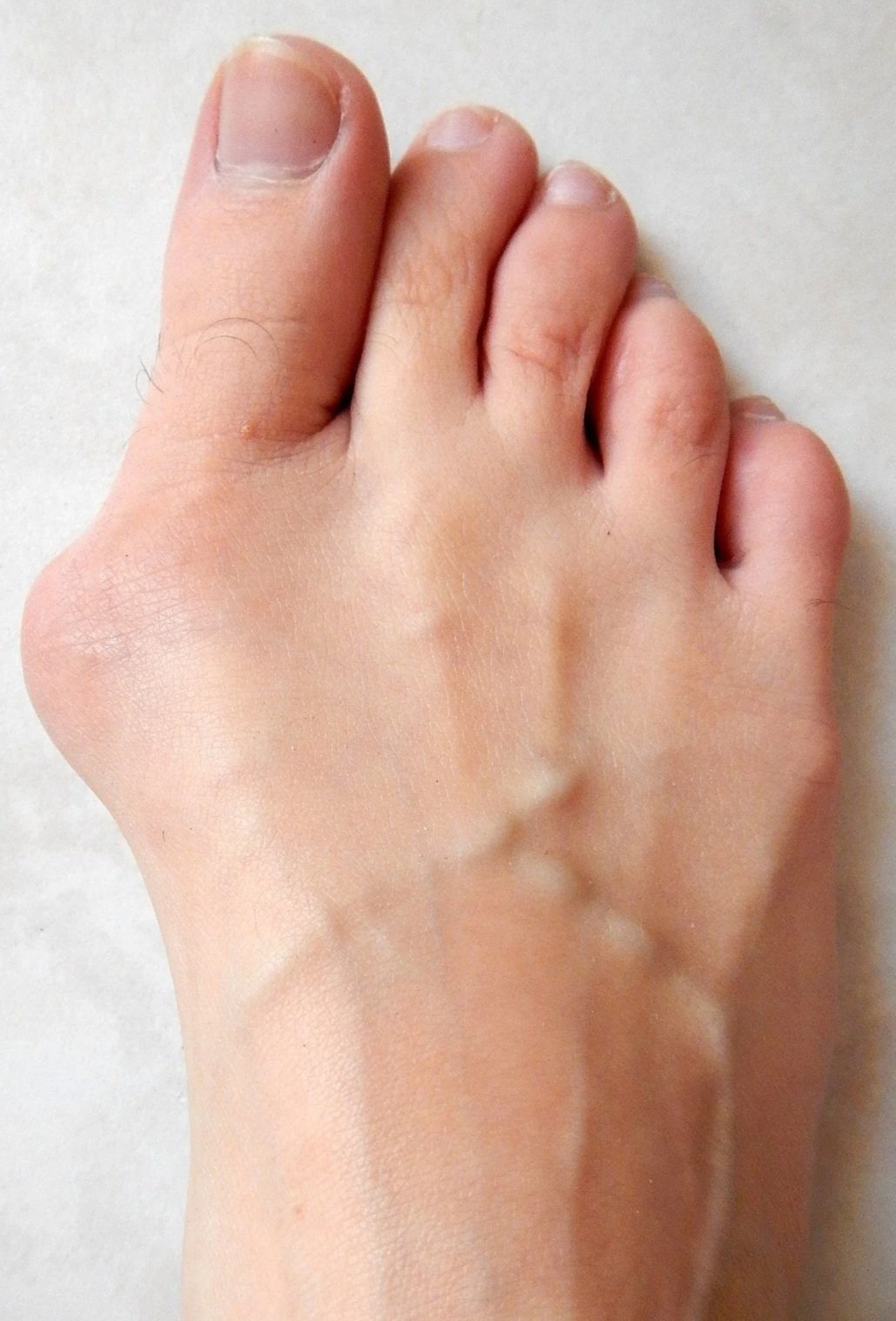 El postoperatorio de la cirugía de juanetes