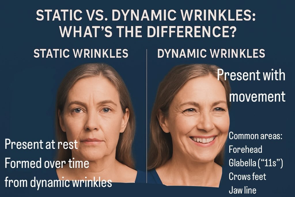 Understanding Baby Tox: A Proactive Approach to Wrinkle Prevention

A common misconception about neurotoxin products is that they can smooth all types of wrinkles. In reality, these treatments are highly effective for dynamic wrinkles, which are caus