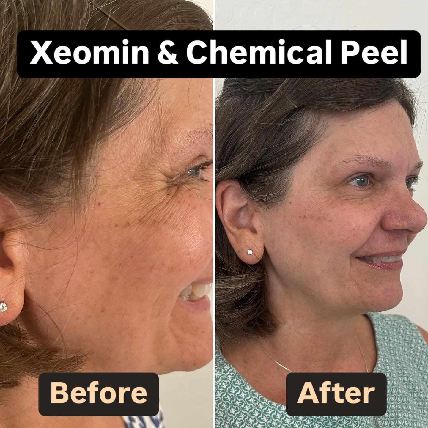 My beautiful mom inside and out. Helped give her skin a refreshed look with Xeomin for the deep wrinkles and a chemical peel to smooth her skin texture, help with fine discoloration, and smoothing of the fine surface wrinkles. Interested in a Xeomin 