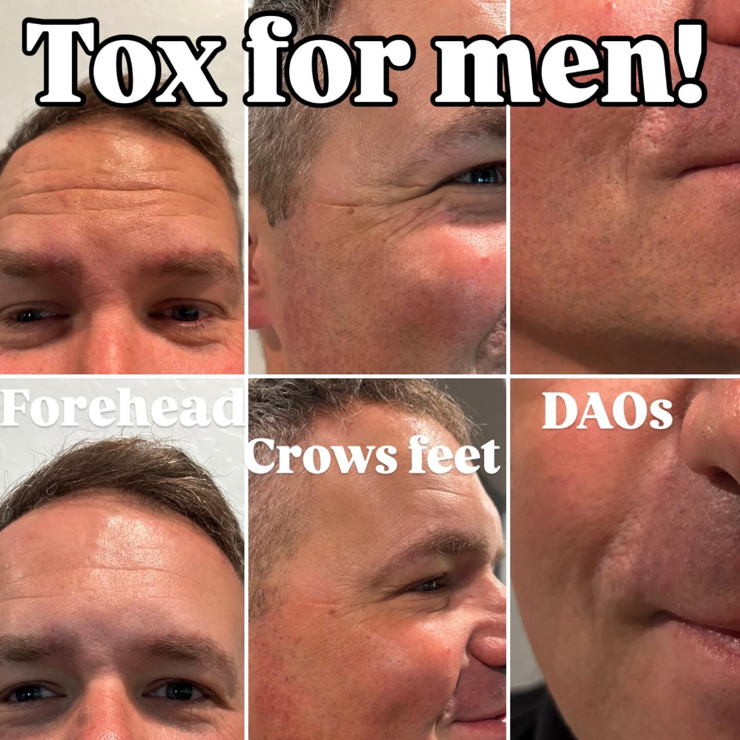 Tox is for men too! Looking for a refreshed look but not overdone? Reach out for more information or book in my profile link! #nofilter #juneskincare #botoxmen #radiantskinandhydration ✨