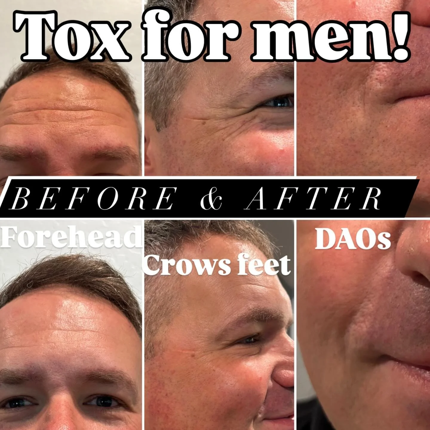 Xeomin in men! More relaxed forehead, less stressed eyes, and turning the resting frown upside down 🙃 🌟 #radiantskinandhydration #juneskin