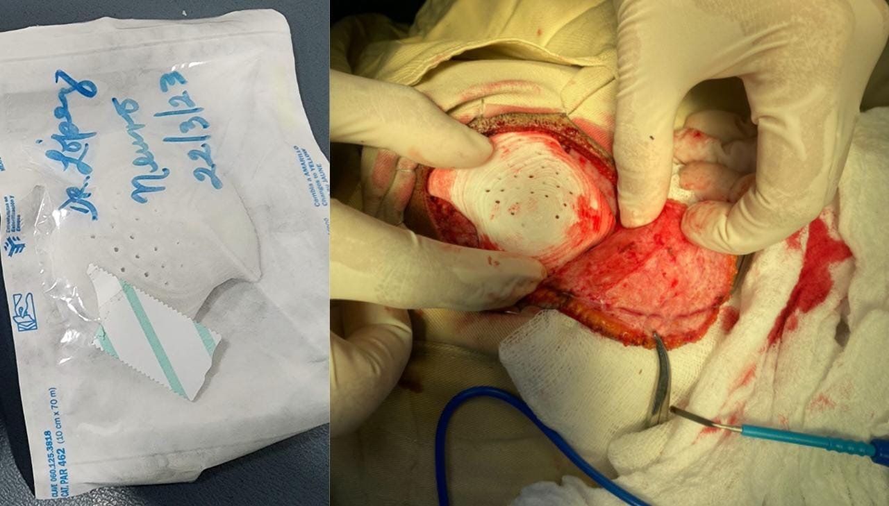 Cranial revision surgery using 3d printed prosthesis fit seamlessly into the skull defect. The material was Bonlecule.