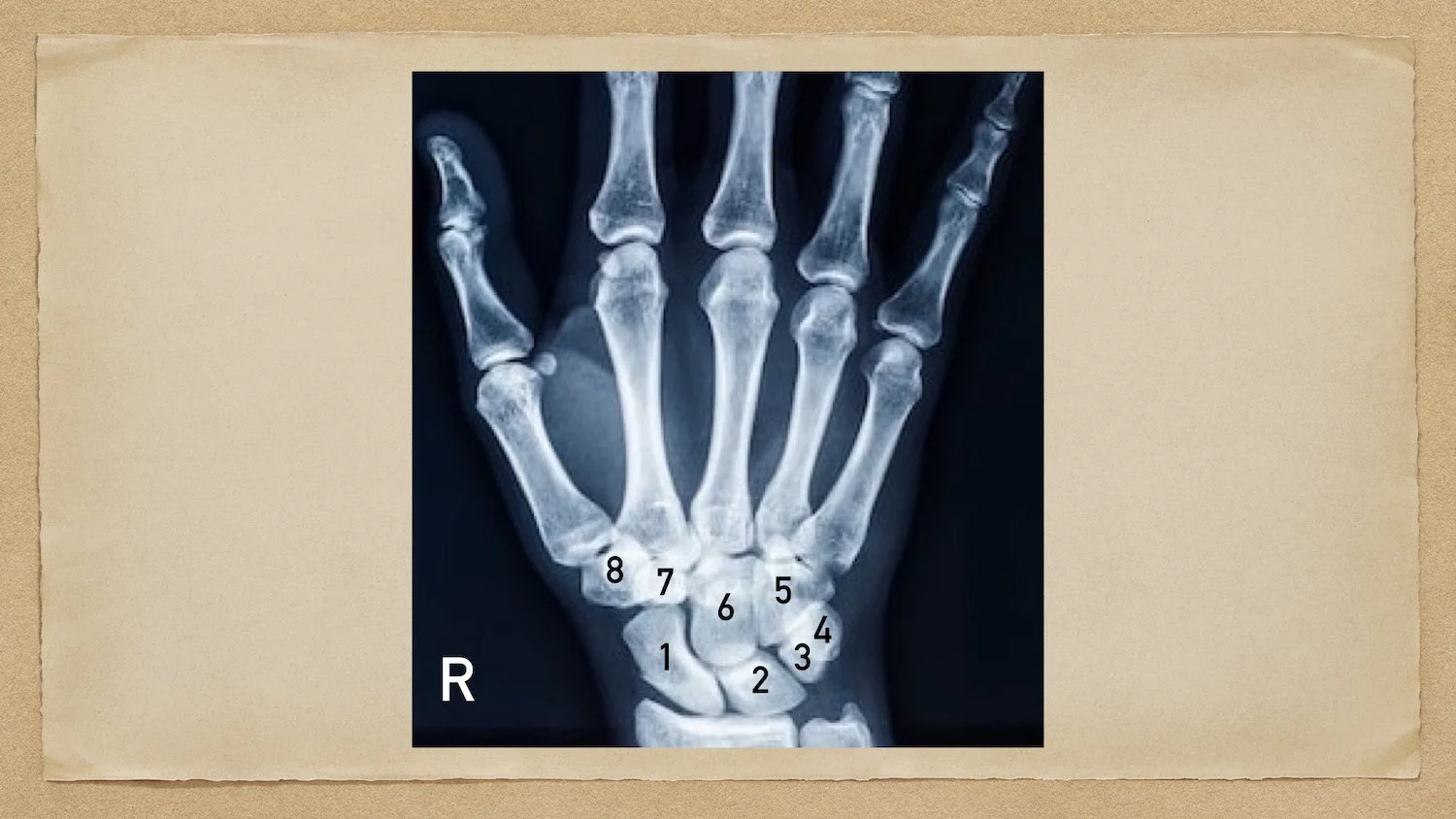 Wrist Anatomy: Carpal Bone Mnemonic