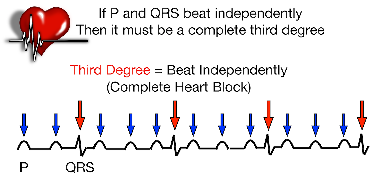 Third-degree heart block: No relationship between P waves (blue arrows) and QRS complexes (red arrows). The electrical signal is completely blocked between the atria and ventricles.