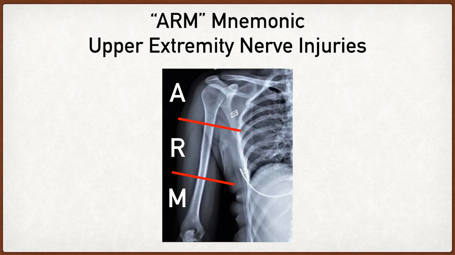 upper extremity nerve injury distribution testing anatomy