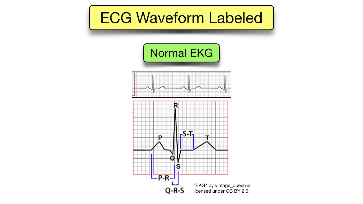 ecg ekg waves labeled waveform explained meaning st segment