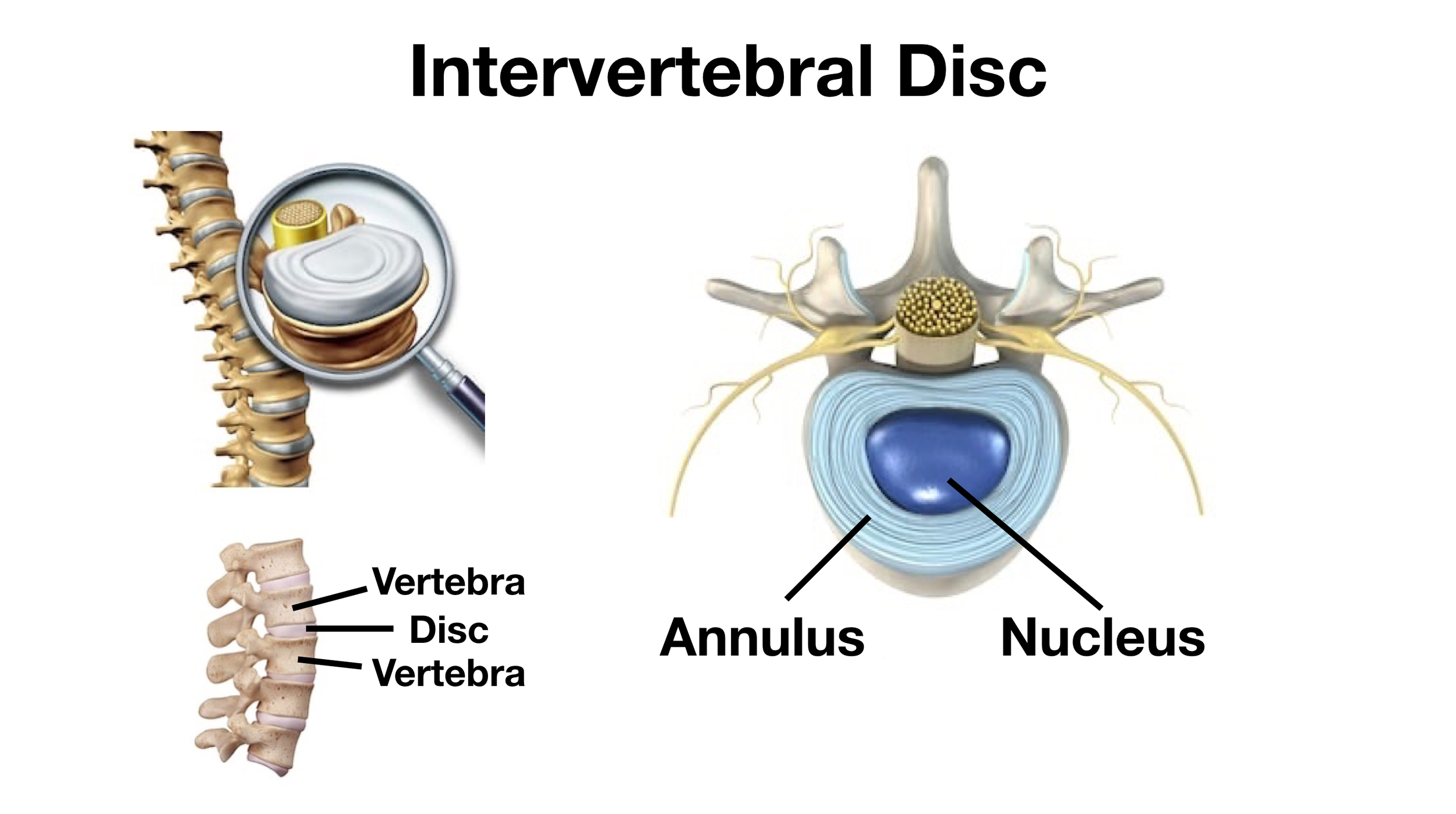 Image: Each intervertebral disc is made up of the annulus (crisscrossed fibers that hold 2 vertebral bodies together) and the nucleus (gel-filled sac that pushes the vertebral bodies away from each other).