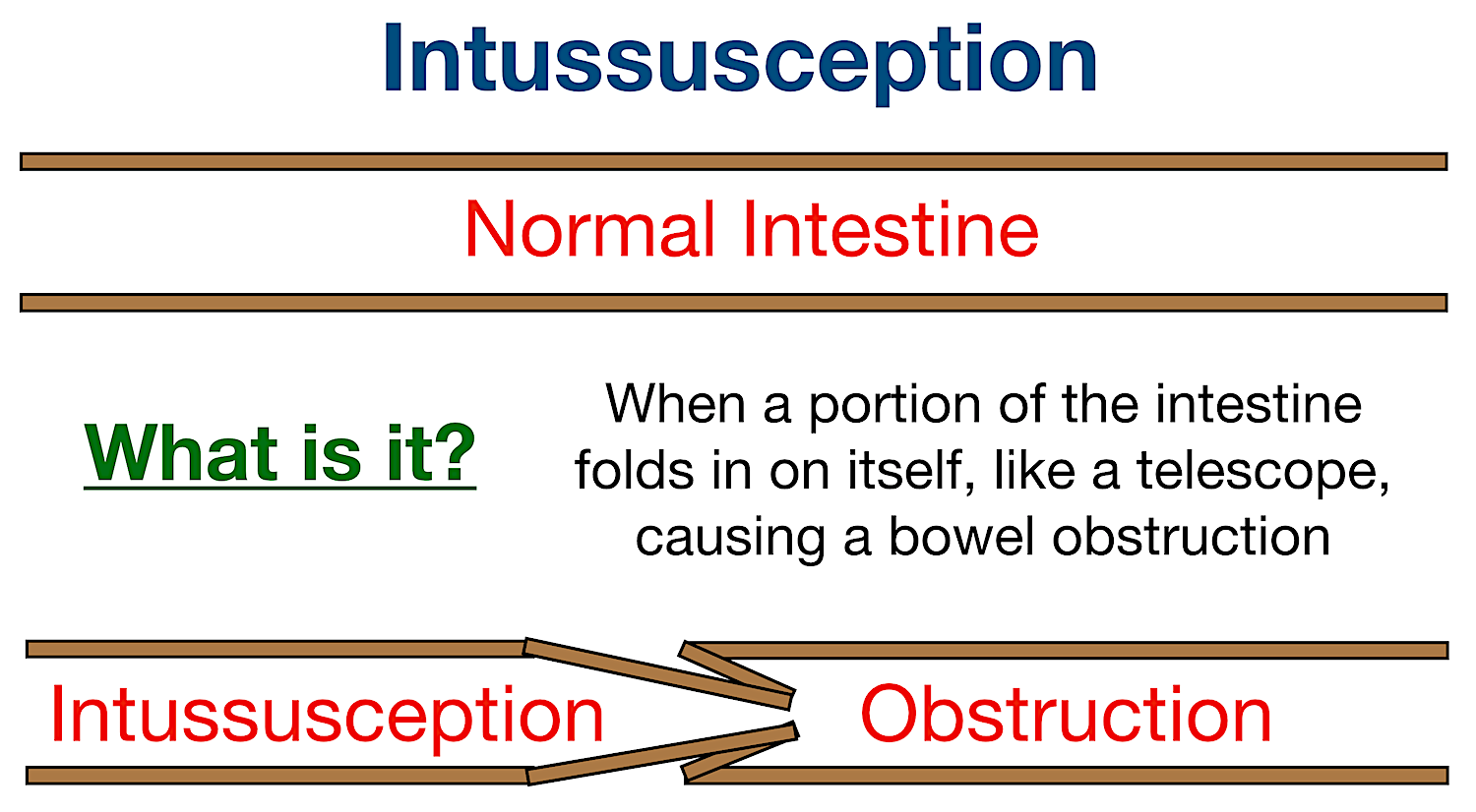 intussusception pronunciation bowel obstruction definition meaning intestines telescope