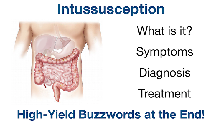 Intussusception: Pronunciation, Symptoms, Causes, Signs, Ultrasound ...