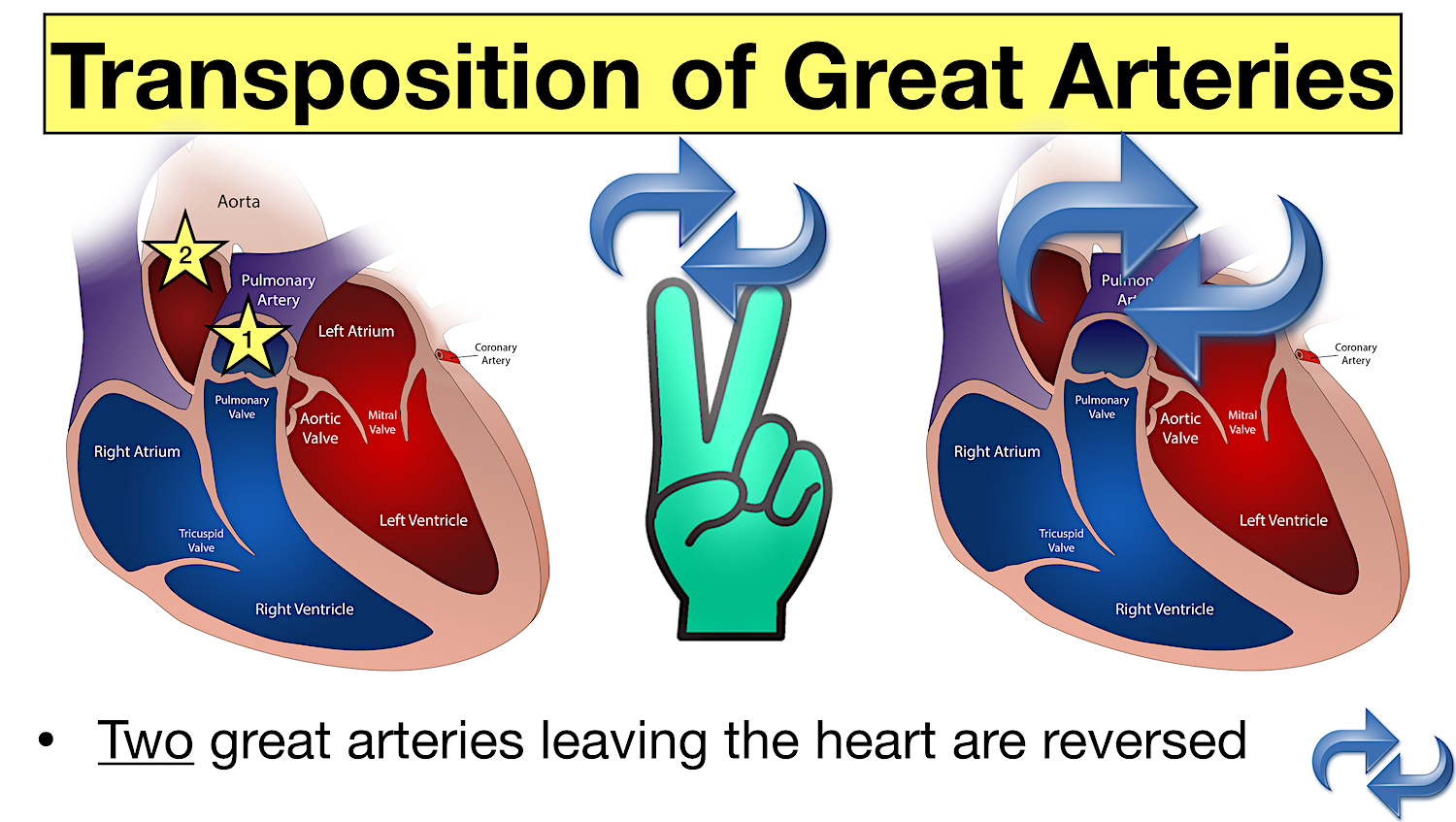 transposition great arteries cyanotic congenital heart defect disease definition