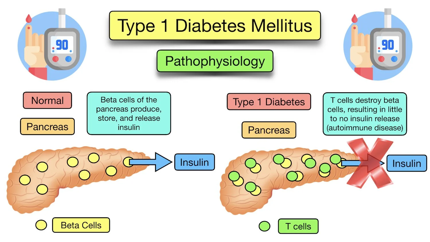 type 1 diabetes mellitus pathophysiology cause autoimmune t cell beta cell