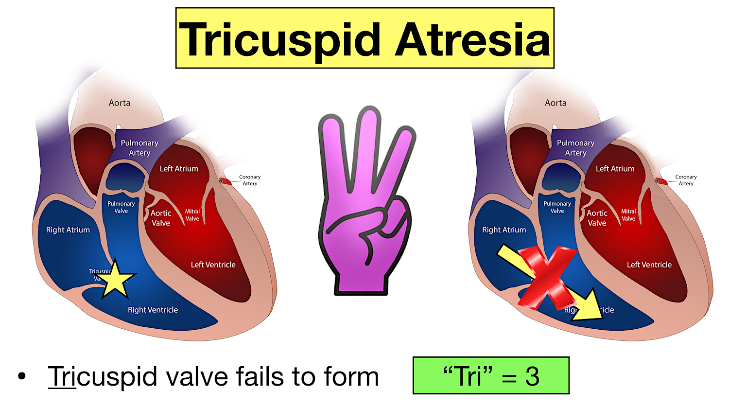 tricuspid atresia cyanotic congenital heart defect disease definition