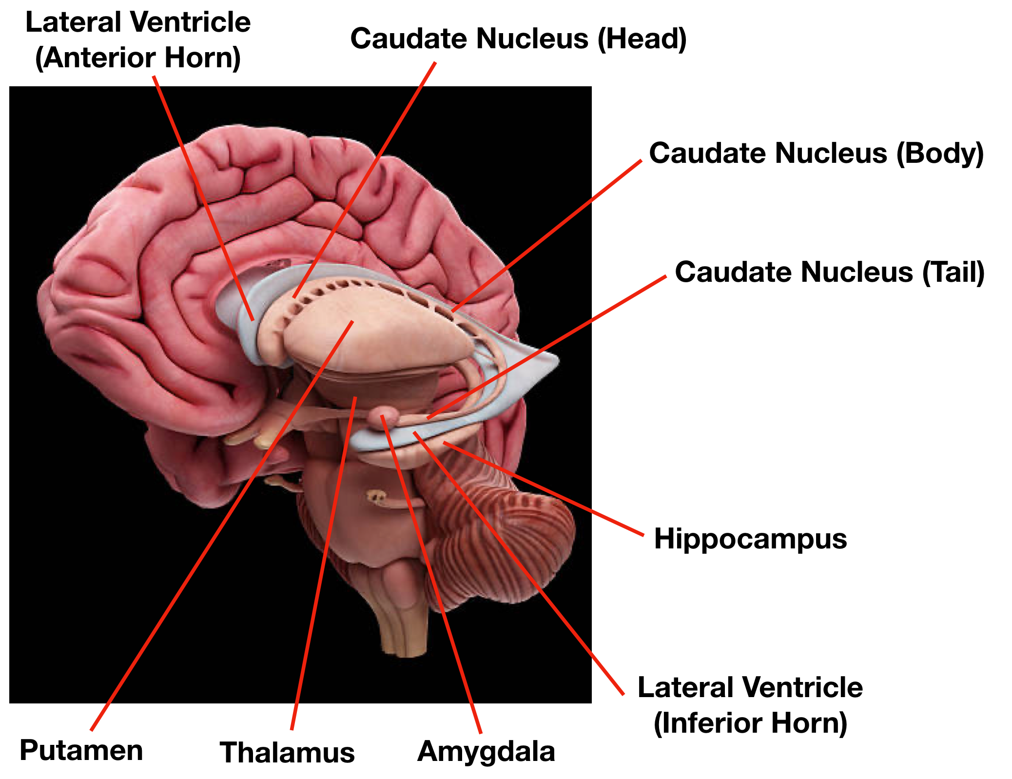 Image (Sagittal View): Appreciate the relationship between the lateral ventricle and caudate nucleus. The head of the caudate nucleus forms part of the floor/lateral wall of the anterior horn of the lateral ventricle.