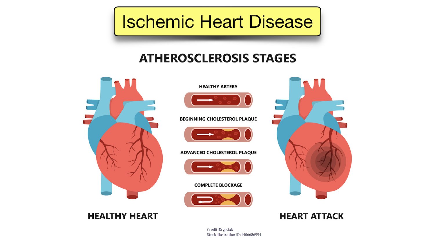 ischemic heart disease icd 10 code definition symptoms atherosclerosis coronary plaque