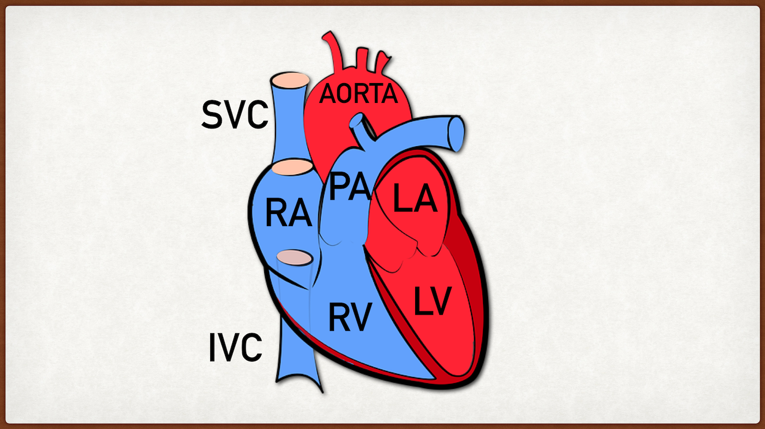 SVC = Superior Vena Cava; IVC = Inferior Vena Cava; RA = Right Atrium; RV = Right Ventricle; LA = Left Atrium; LV = Left Ventricle; PA = Main Pulmonary Artery/TrunkTricuspid Valve = Located between the RA and RV; Mitral Valve = Located between the L…