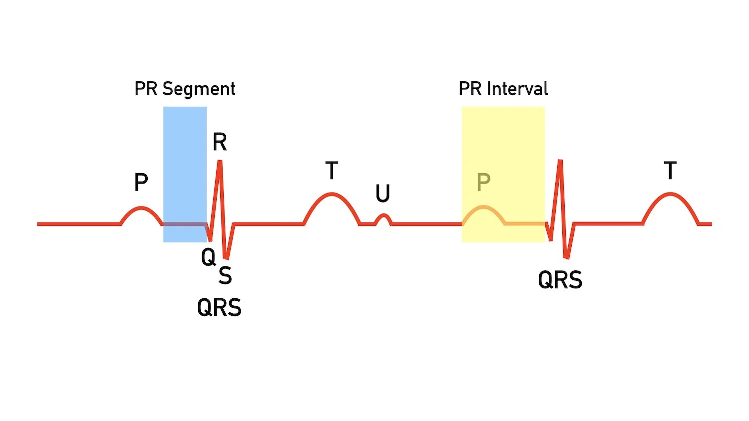pr interval vs pr segment ecg wave explained labeled components diagram