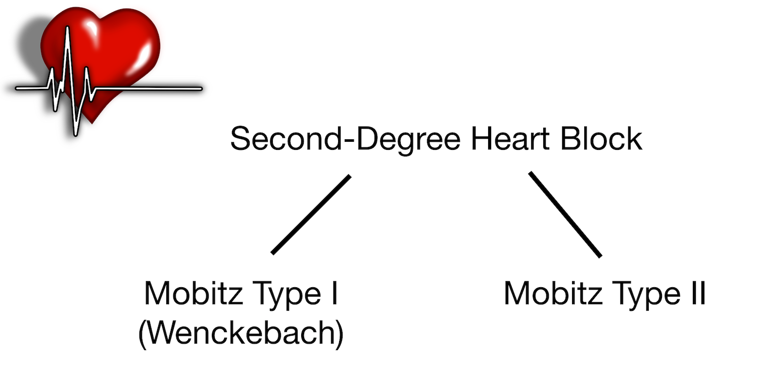 Second-degree heart block types: Mobitz I (Wenckebach) and Mobitz II