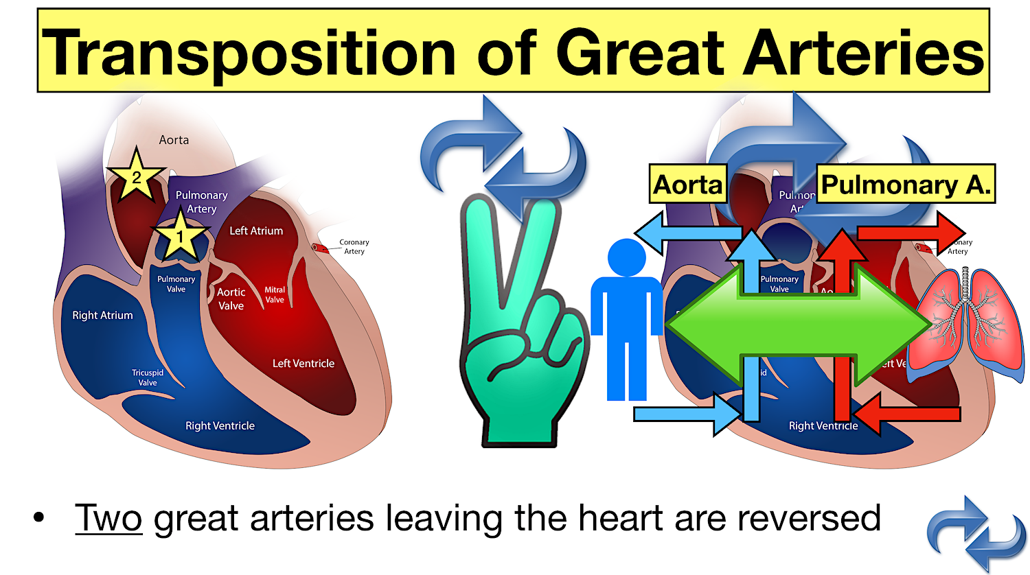 transposition of great arteries cyanotic congenital heart defect