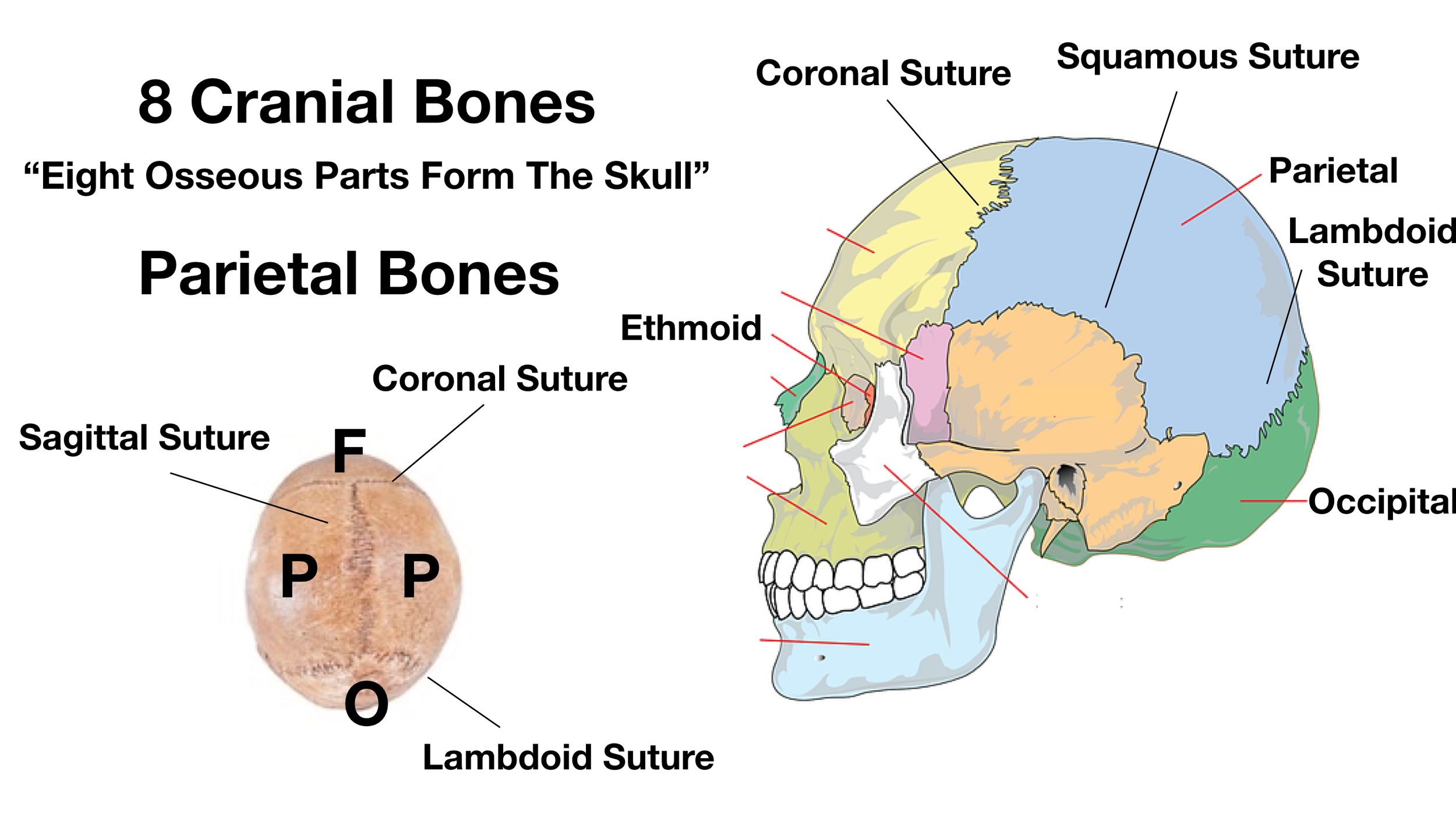 Image: The sagittal suture connects the 2 parietal bones (P) together at the top of the skull. The coronal suture attaches the parietal bones to the frontal bone (F). The lambdoid suture connects the parietal bones to the occipital bone (O).