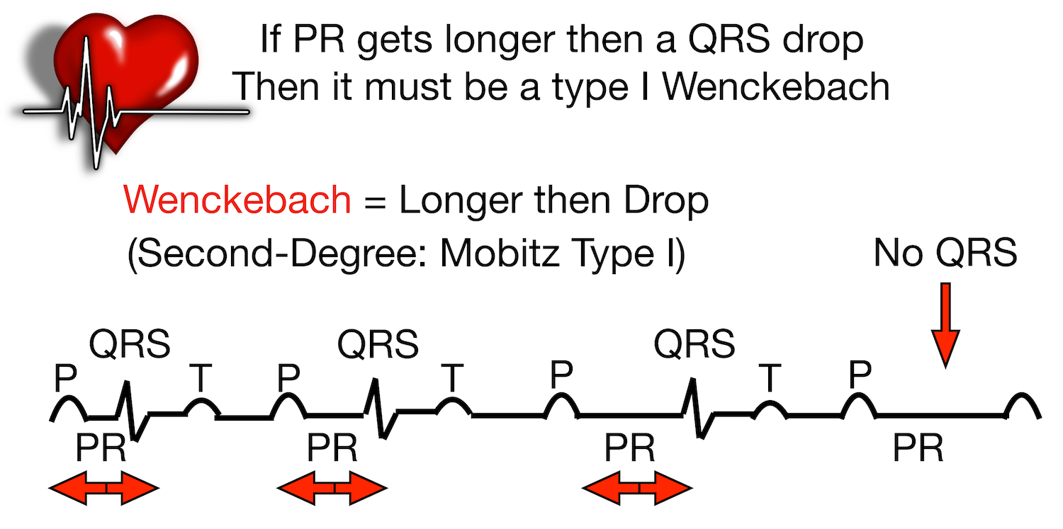 Mobitz Type I (Wenckebach): PR interval progressively lengthens then a QRS drop