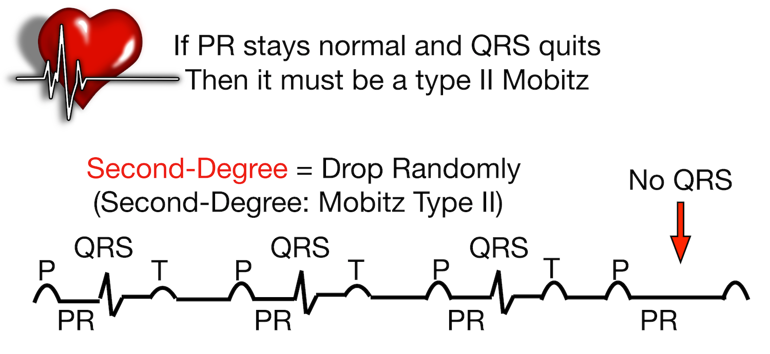 Mobitz Type II: Contant PR interval with intermittent QRS drop