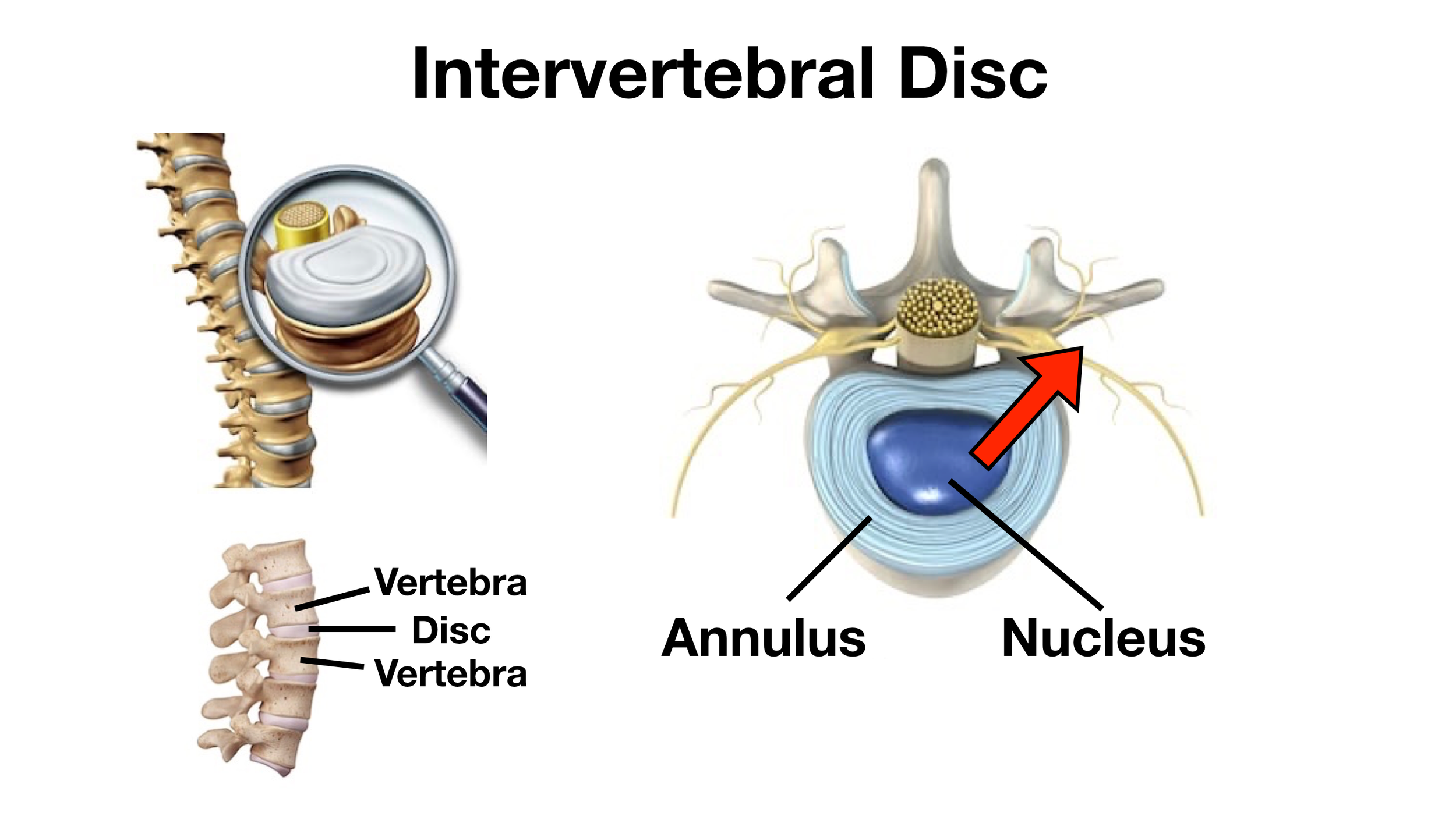 Image: An intervertebral disc can herniate in which the nucleus protrudes through the annulus and potentially compresses nearby spinal nerves.
