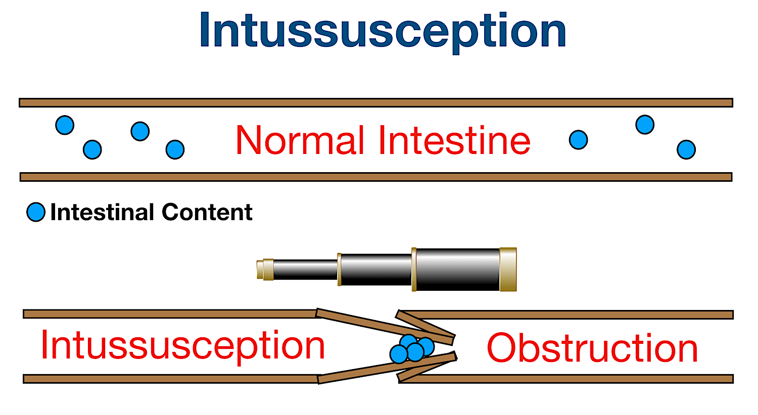 intussusception pronunciation bowel obstruction definition meaning explanation