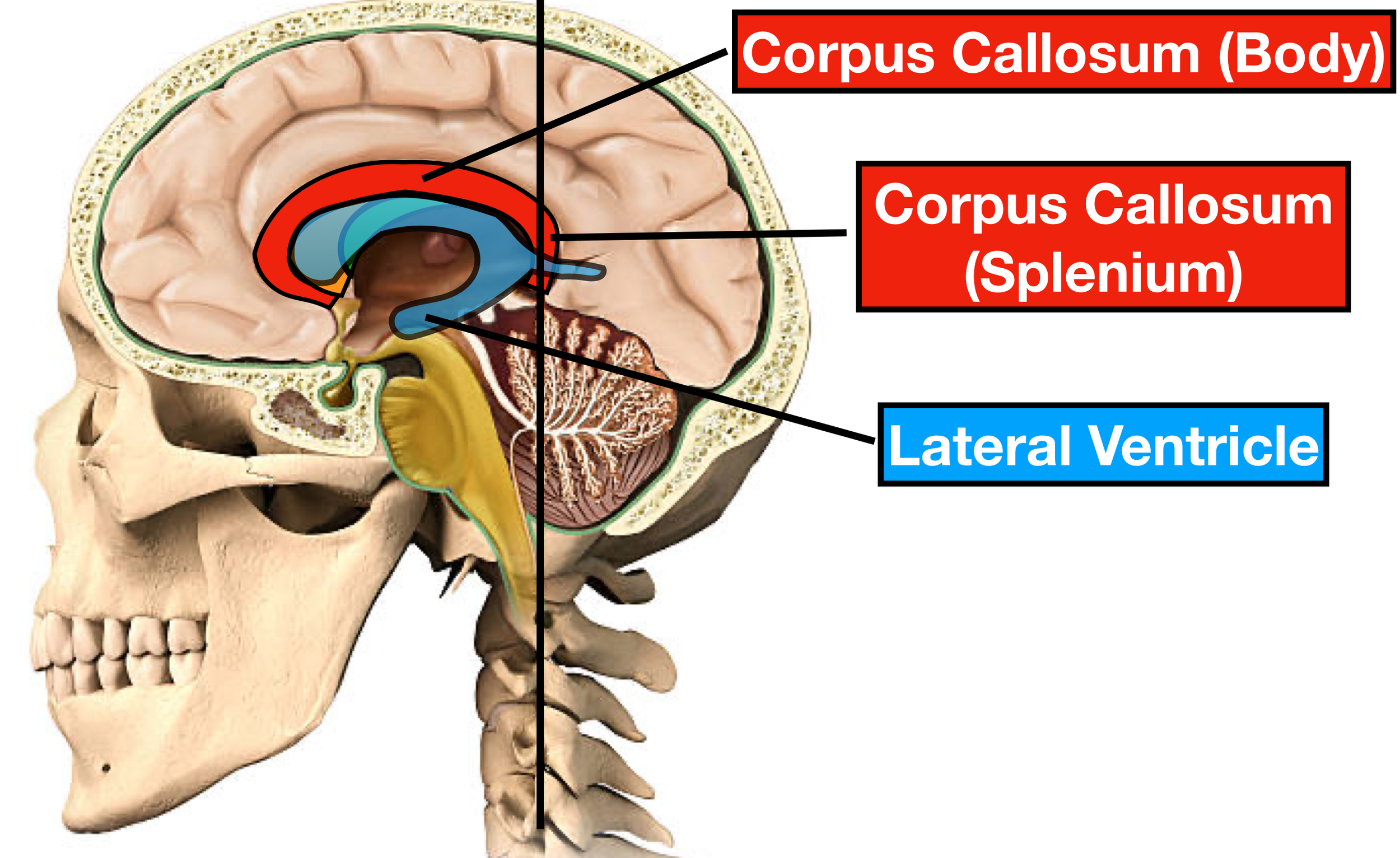 Image (Sagittal View): The vertical black line traverses the posterior horn of the lateral ventricle. Fibers from the splenium of the corpus callosum form the medial wall, roof, and lateral wall of the posterior horn - see next image below.