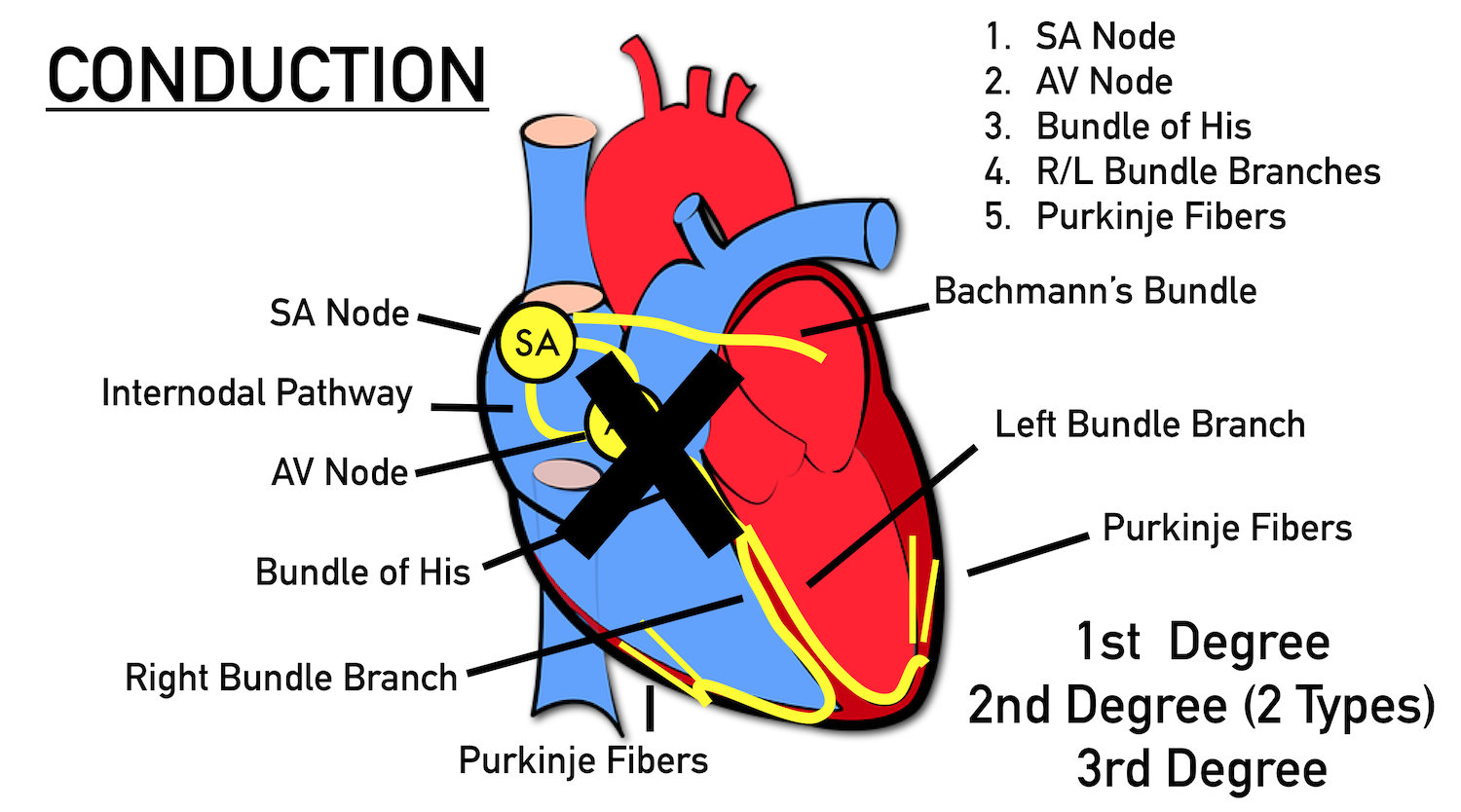 AV heart block definition: Interruption of electrical transmission from the atria to the ventricles