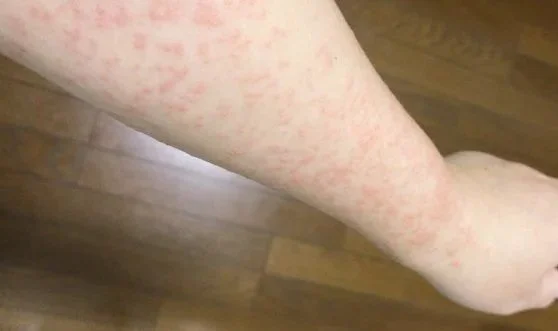 チャドクガ刺される