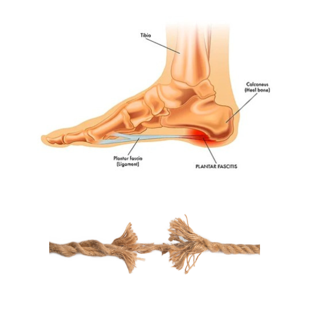 Diagram of a foot showing Achilles tendinitis, including the calcaneus bone, tibia, plantar fascia, and inflammation