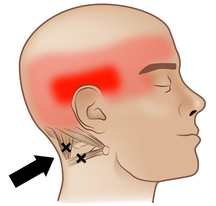 tension headache