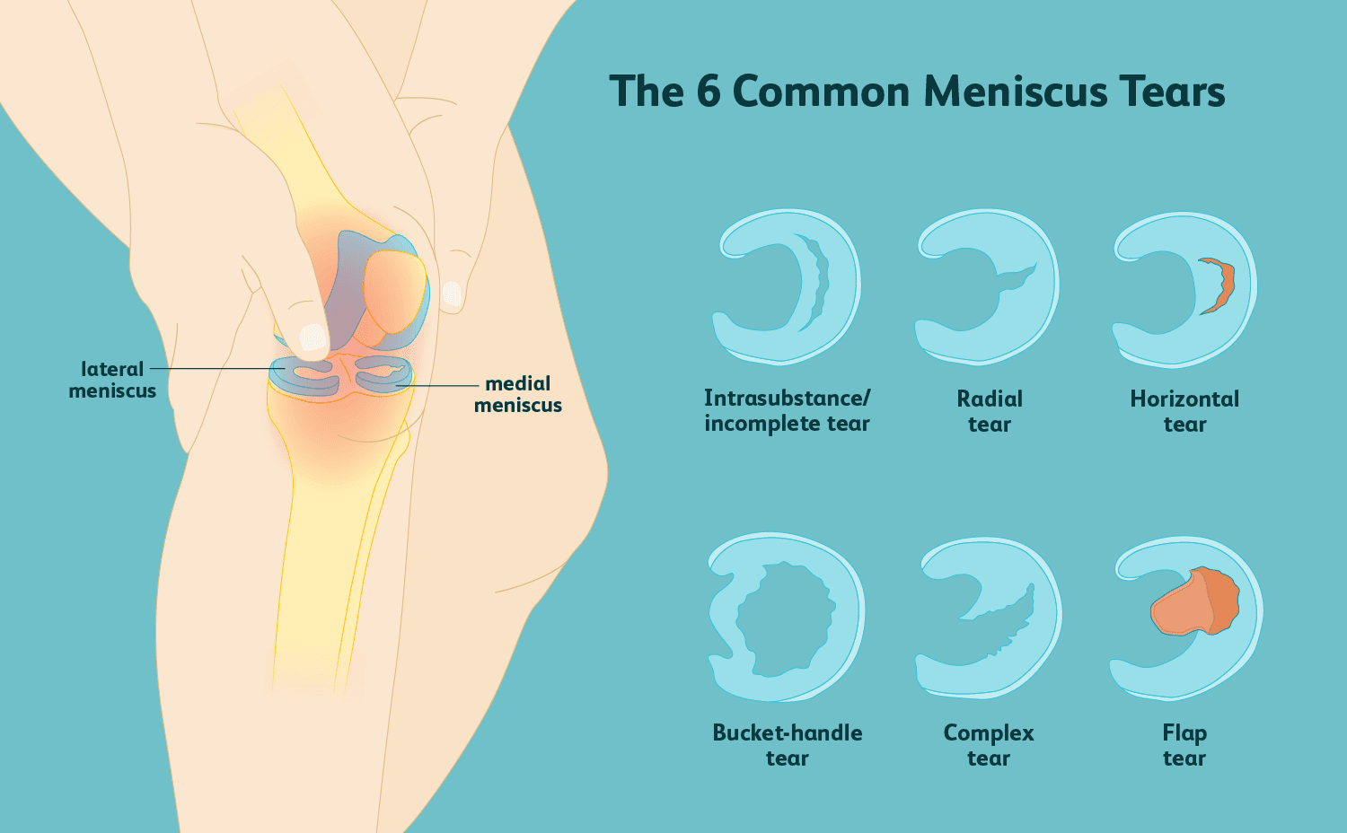 Meniscus Injury