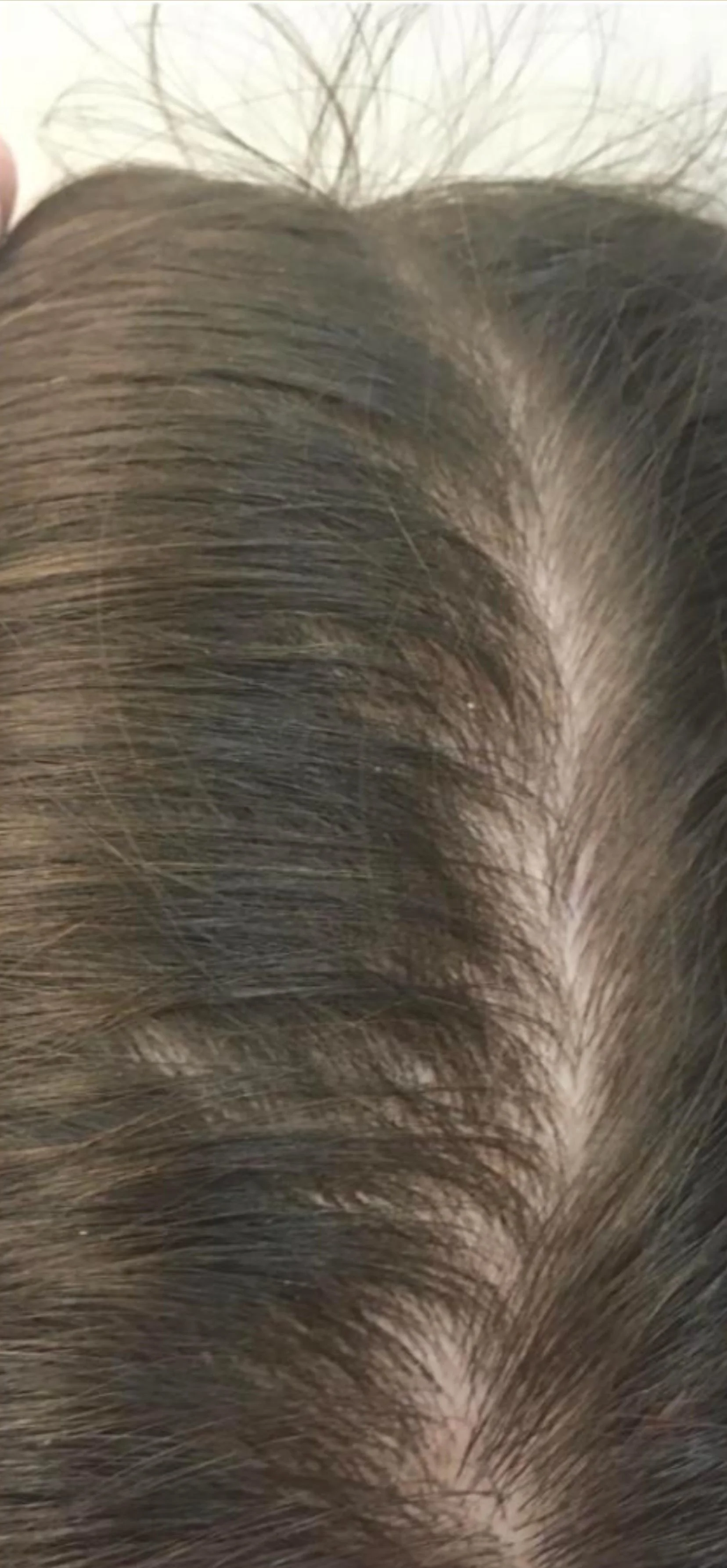 Close-up van een hoofdhuid met bruin haar en een duidelijke haarlijn.