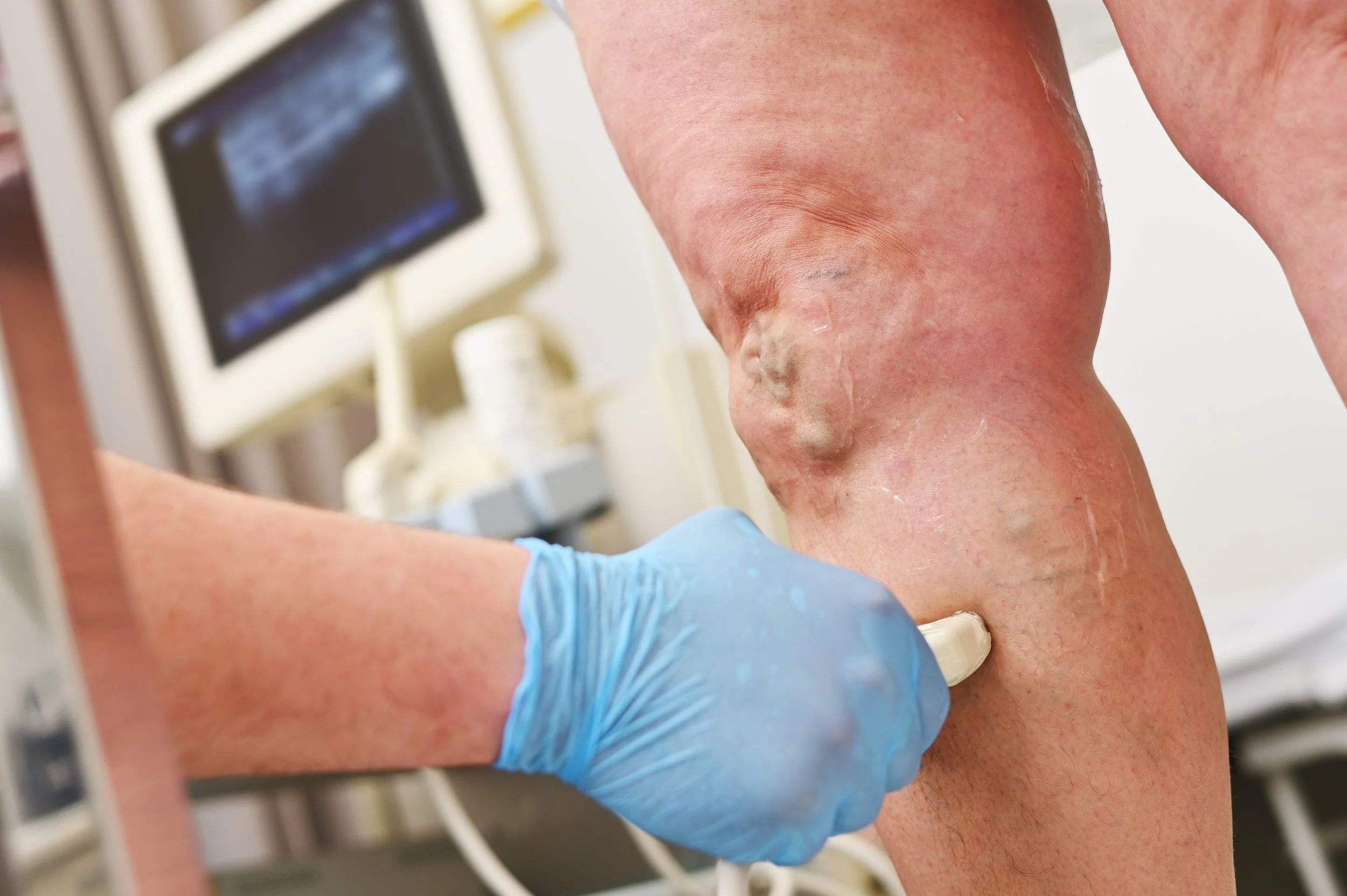 Varicose Vein Removal