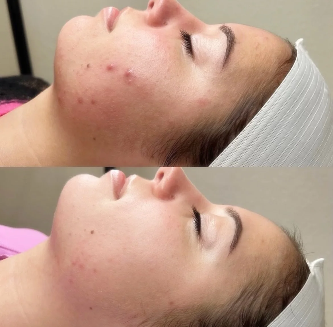 ✨ Skin Transformation ✨

Ich habe wieder eine mega Ergebnis f&uuml;r euch von meiner lieben Nele. 
&bull;
&bull;
Ganzheitliche Hautpflege ist der Schl&uuml;ssel zu einer gesunden und strahlenden Haut. Sie verbindet &auml;u&szlig;ere Pflege mit einer 