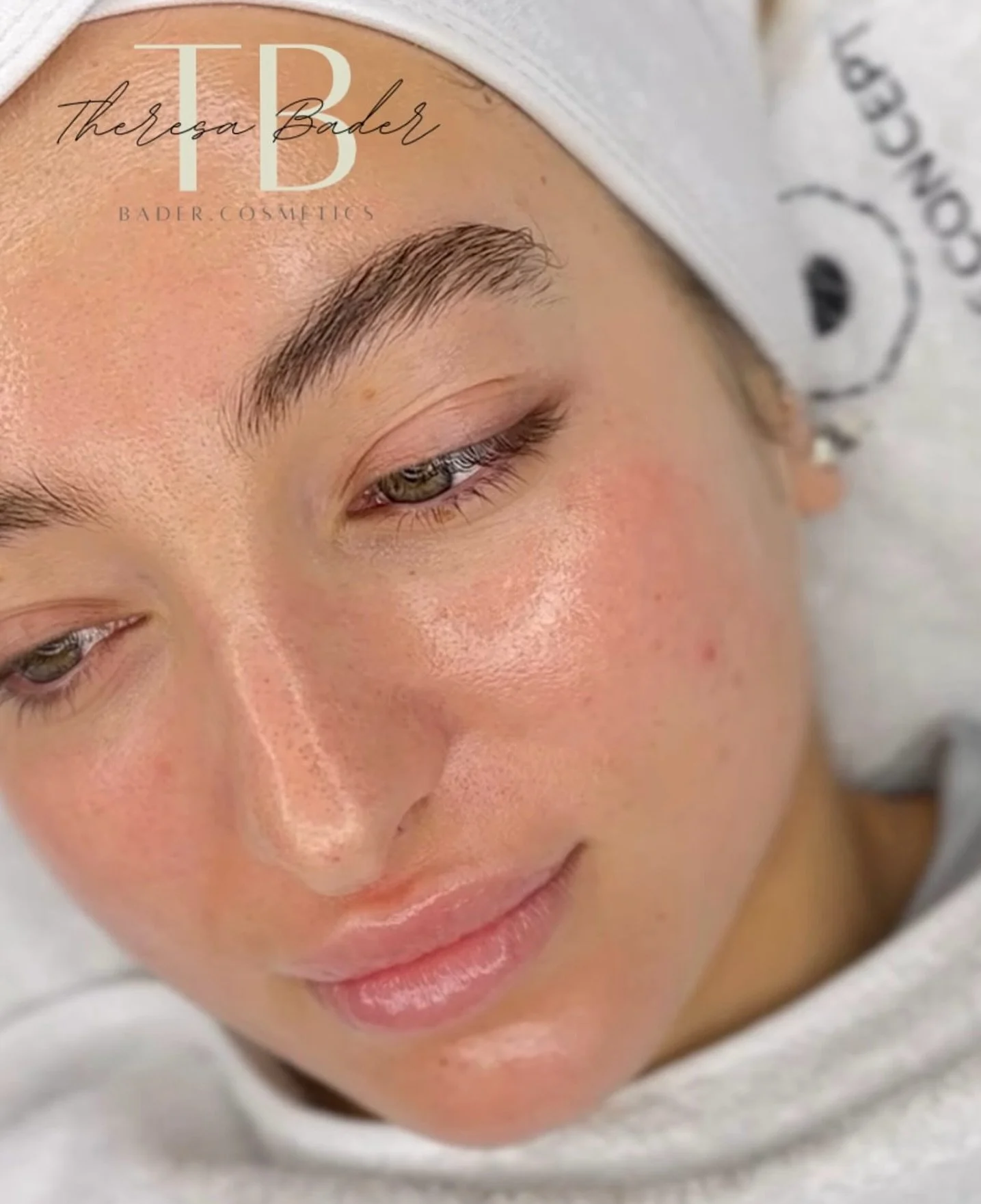 ✨🤍 After AquaFacial Glow ✨🤍