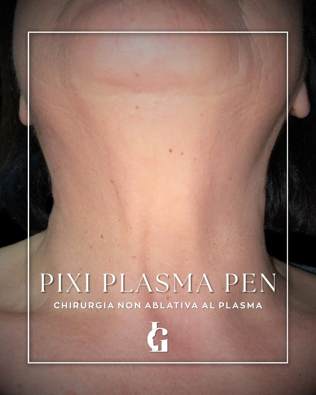 Come rimuovere le piccole lesioni di collo e viso senza bisturi. 🩹✨

I fibromi penduli sono piccole escrescenze della pelle del tutto benigne, ma che spesso creano fastidio estetico o irritazione, specialmente in zone delicate come il collo o il con