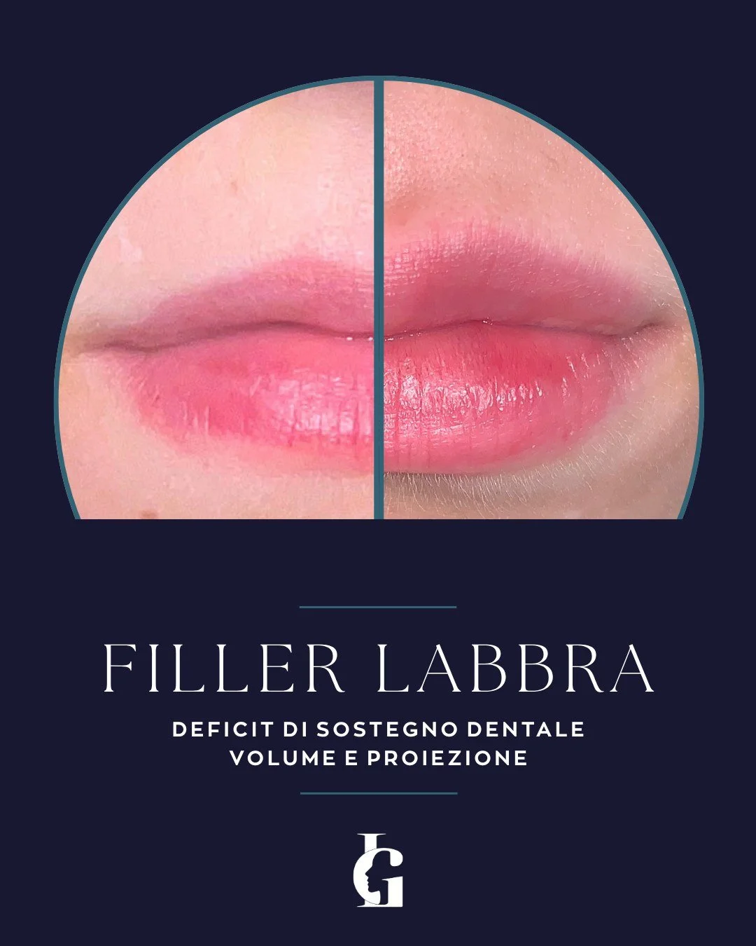 L'approccio clinico alle labbra costituzionalmente sottili richiede un'attenta valutazione delle strutture di sostegno sottostanti, inclusa l'eventuale presenza di un ridotto supporto dentale posteriore.

In questo caso, l'obiettivo era ottenere una 