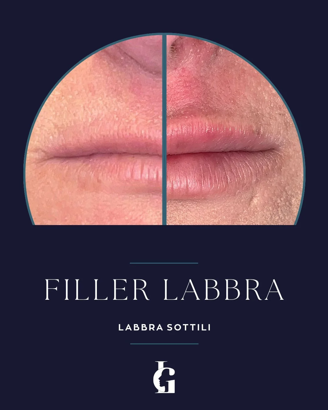 Valorizzare le labbra sottili &egrave; un'architettura che si sviluppa per gradi. Evito i sovraccarichi immediati per ricercare un'armonia progressiva, stabile. Forzare i tessuti compromette l'anatomia e crea risultati artificiali.

Un percorso a tap